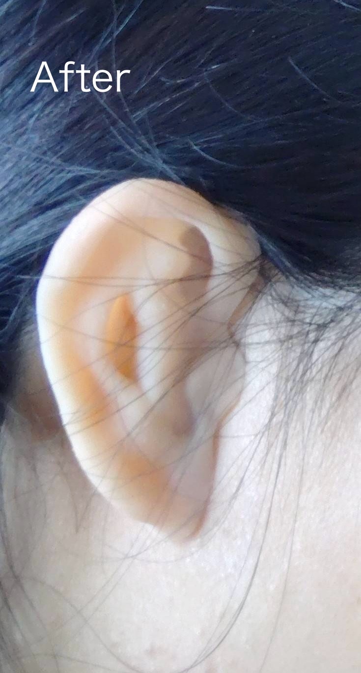 非対面で製作した耳エピテーゼ(人工耳・義耳)を装着した状態(例)