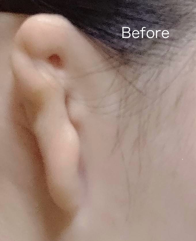 非対面で耳エピテーゼ(人工耳・義耳)を作る前の小耳症のお耳の状態(例)